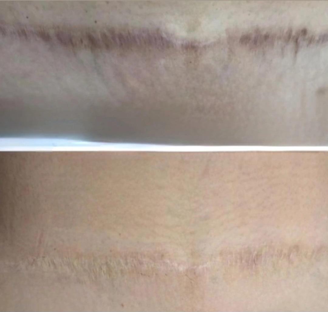 Medical tattoo result 1