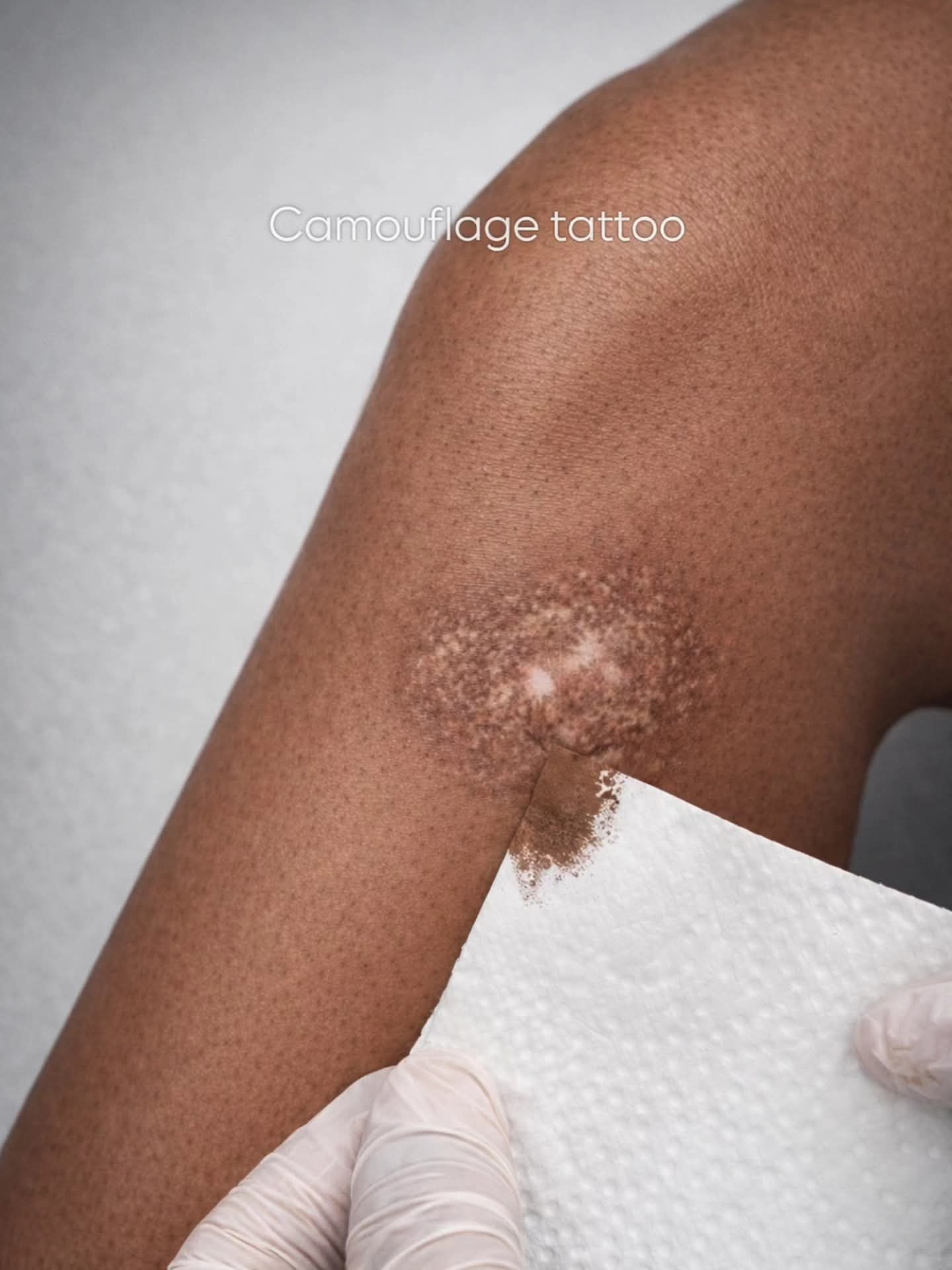 Medical tattoo result 4