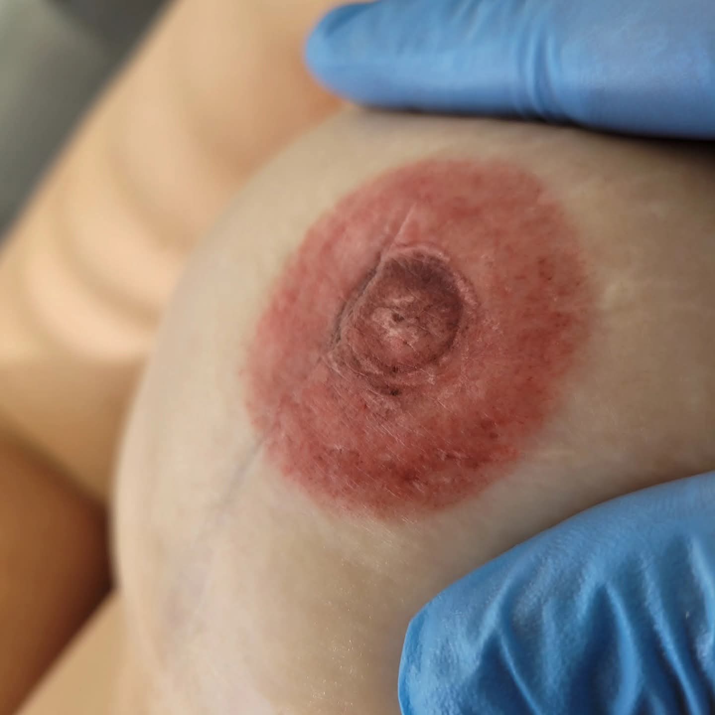 Medical tattoo result 10