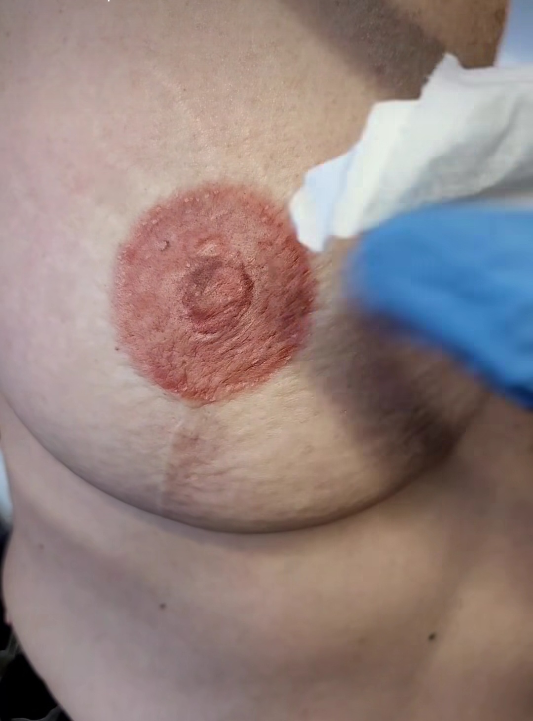 Medical tattoo result 8