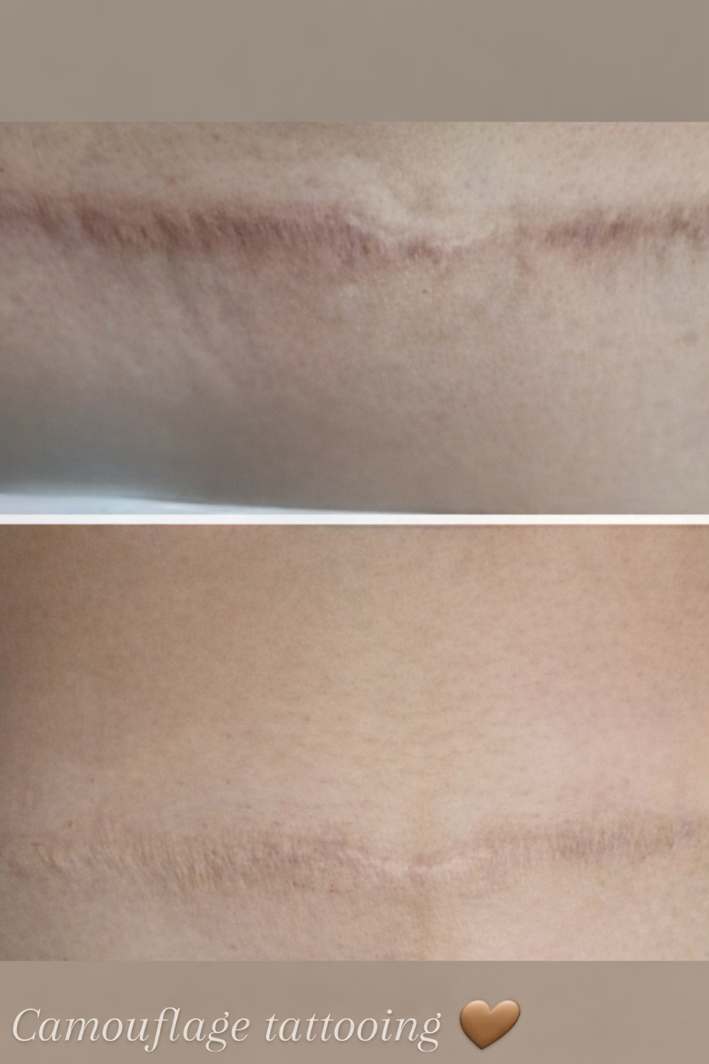 Medical tattoo result 1